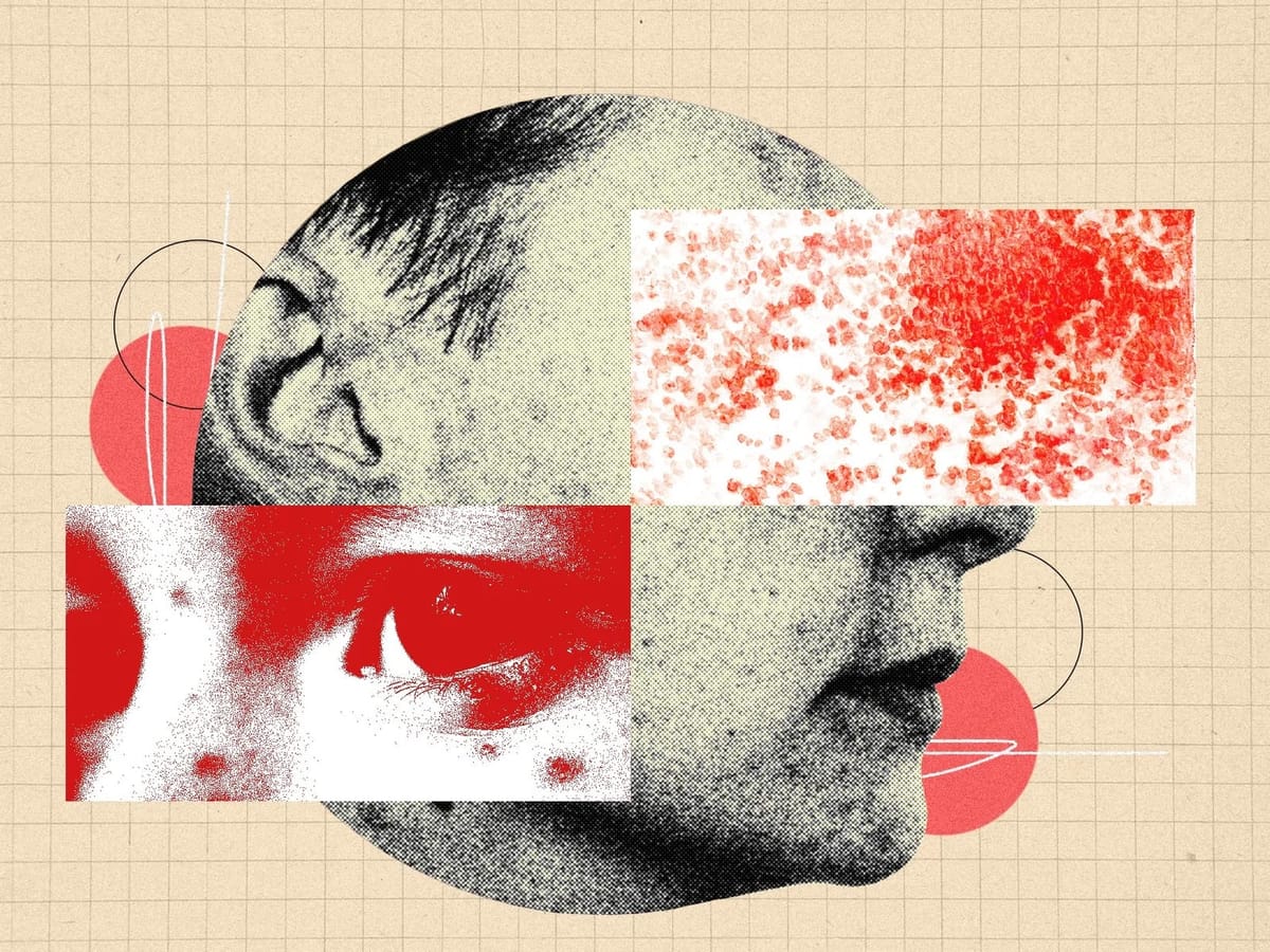 你应该对带状疱疹感到更加恐惧